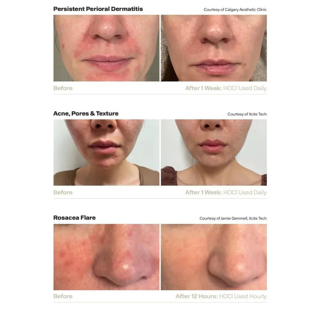 Hale Derma Hypochlorous Acid Skin Mist – 2oz soothing facial mist for hydration, redness reduction, and calming irritation. Ideal for sensitive and acne-prone skin to promote clear, healthy complexion.