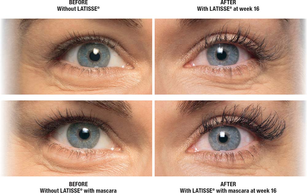 Latisse for thicker lashes- Modern You Medical Aesthetics Skin Care Store